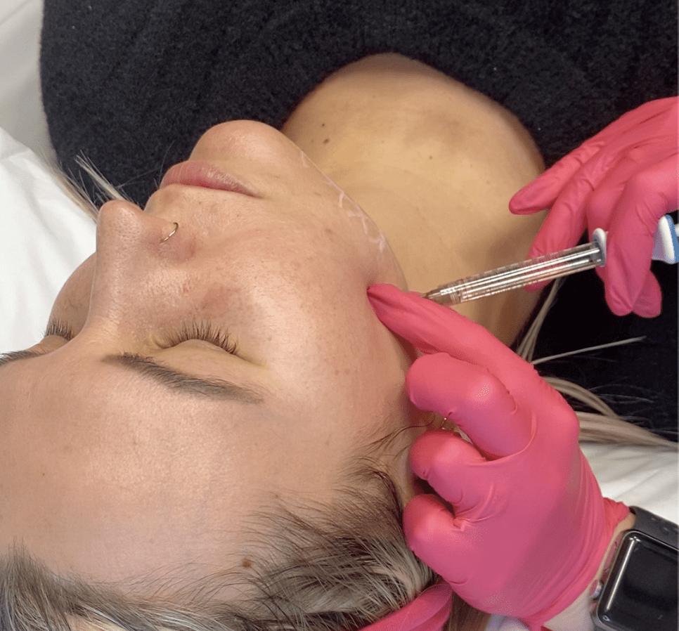 Jawline Filler Volux MONA Dermatology Cincinnati